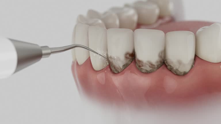 Trusted Dental Crowns And Bridges service in North Plainfield, NJ - Dentist Open Now